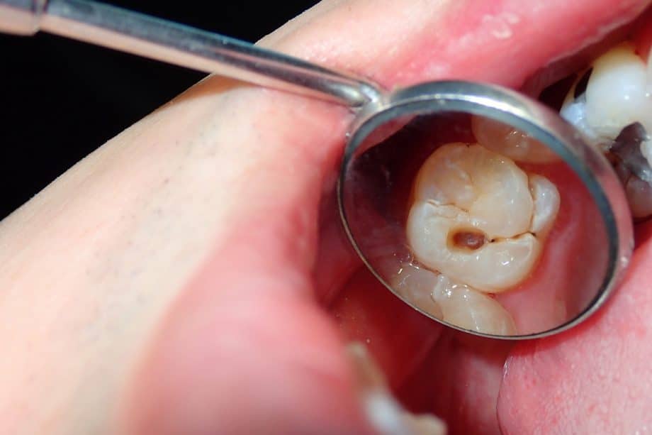 Can A Cracked Tooth Heal On Its Own?