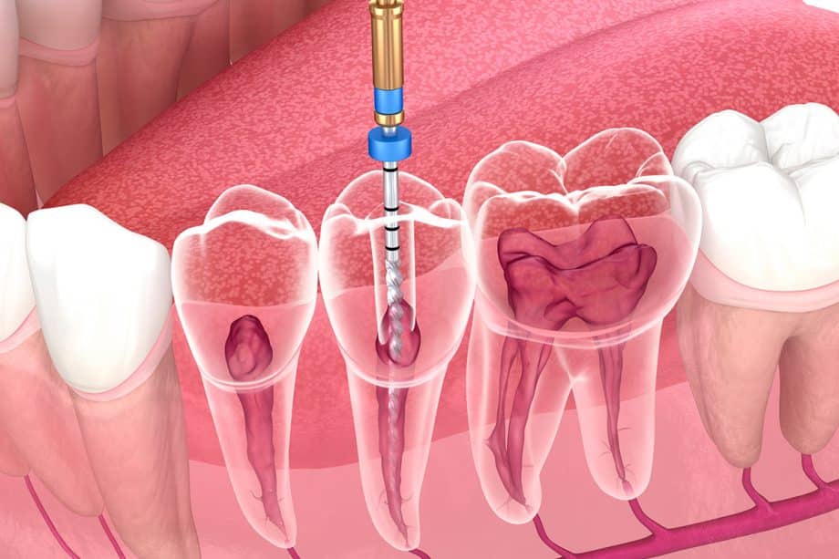 Choose Endodontic Care In A Dental Emergency