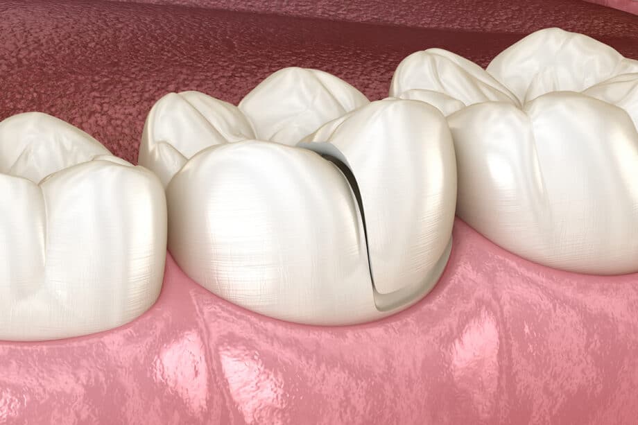 How to Tell If You Have a Cracked Tooth