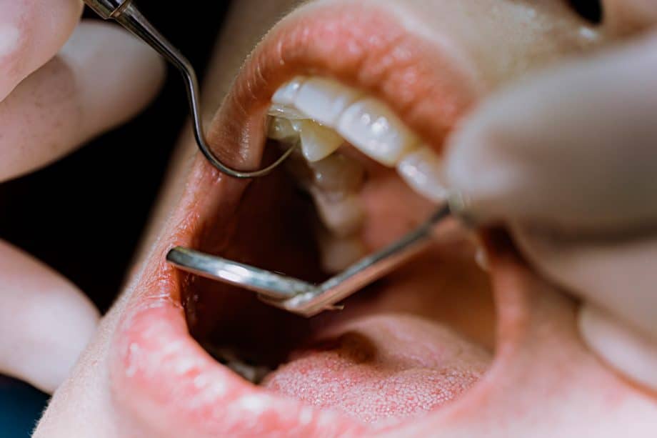 What Happens If You Don’t Get A Root Canal?
